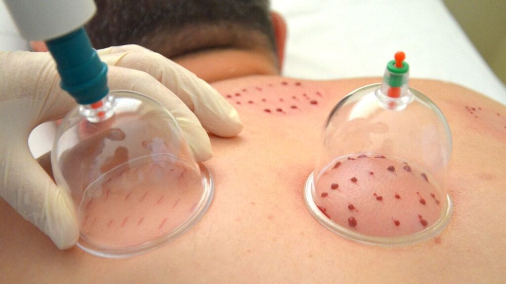 Wet hijama cupping therapy at Sun Yoga & Therapy Guduvancheri Chennai